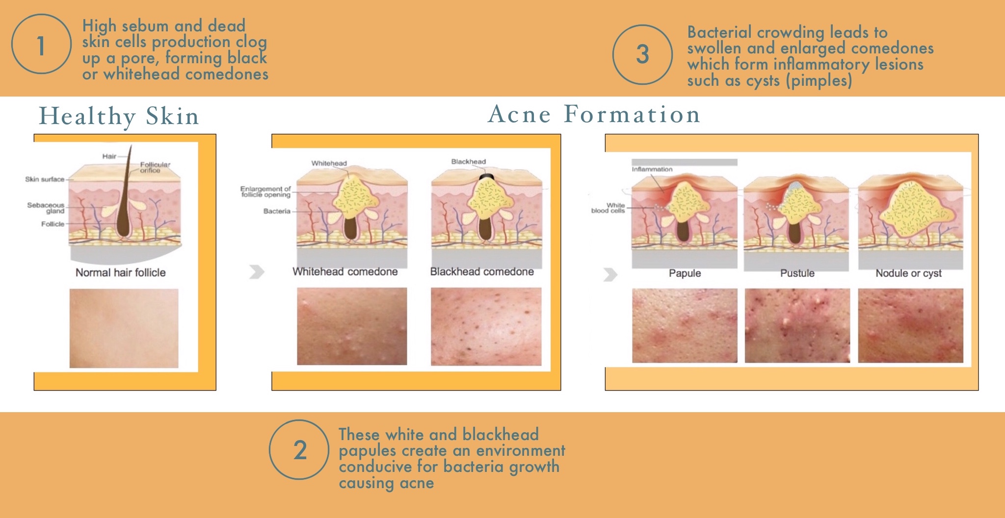 Acne Formation